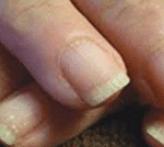 Brittle nails
